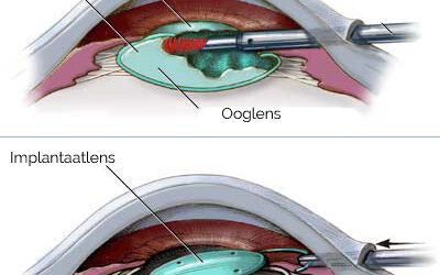 Ooglens vervangen